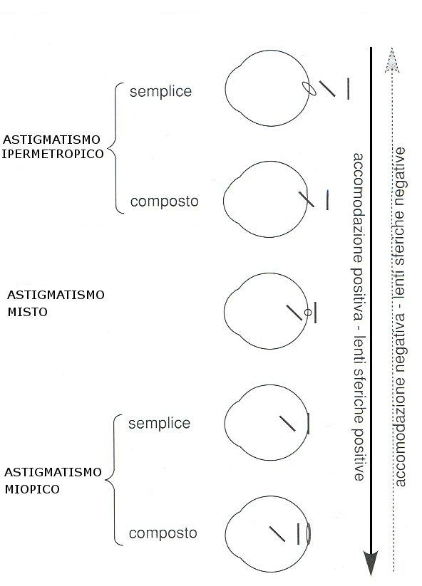 Gradazione Lenti A Contatto Miopia E Astigmatismo
